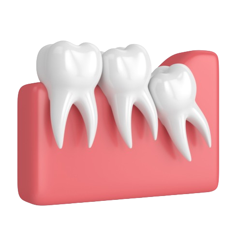 3d render of teeth with wisdom crowding