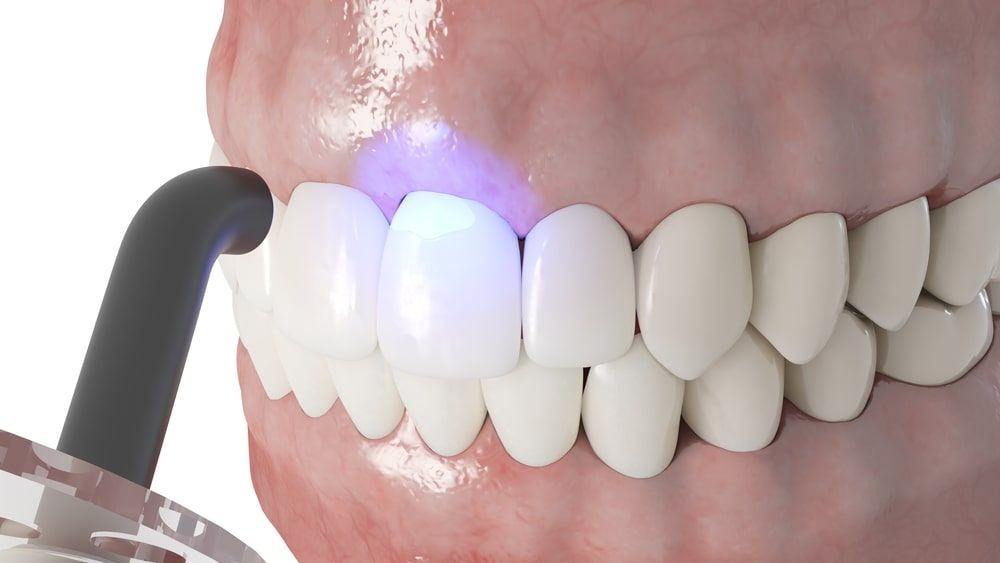 3d rendered illustration of a dental bonding process
