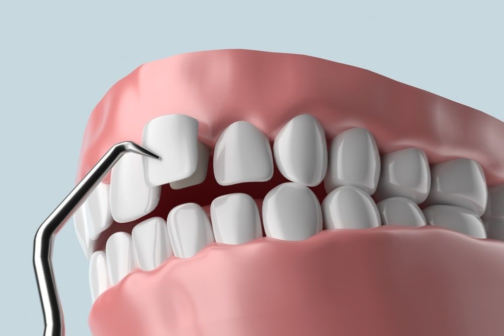 Veneer installation procedure over central incisor and lateral incisors