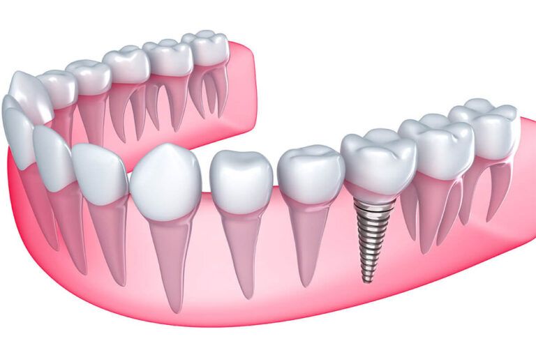 Are dental implants worth the cost