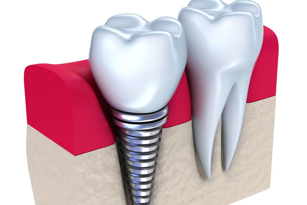 Customized replacement options for missing teeth