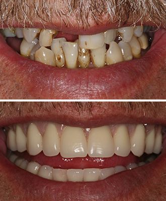 Dental Crowns Before After