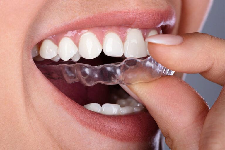 Invisalign clear aligners