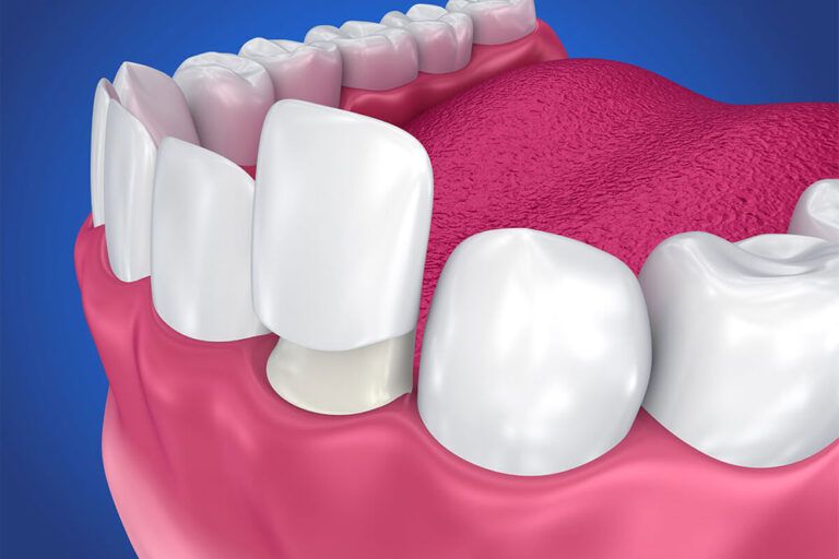 Dental Veneers