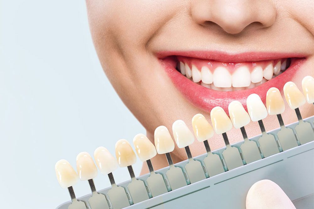 Patients ask about porcelain veneers