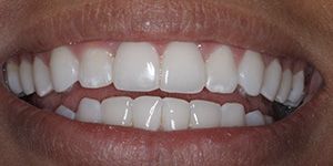 the teeth close-up after hygiene and bleaching