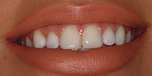 Veneers Before 2