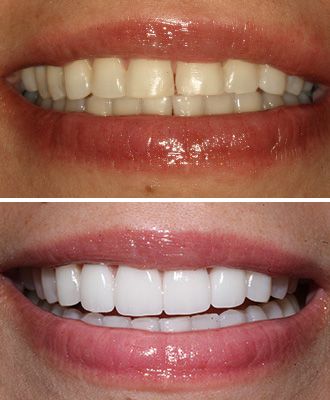 lynda-before-after-veneers