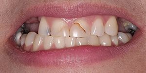 teeth-before-veneer