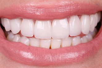 after-full-smile-veneers