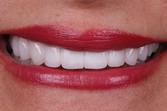 after-porcelain-crowns-veneers-6-small