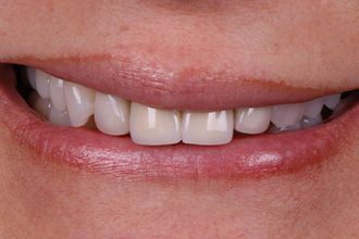 before-porcelain-crowns-veneers-6-small