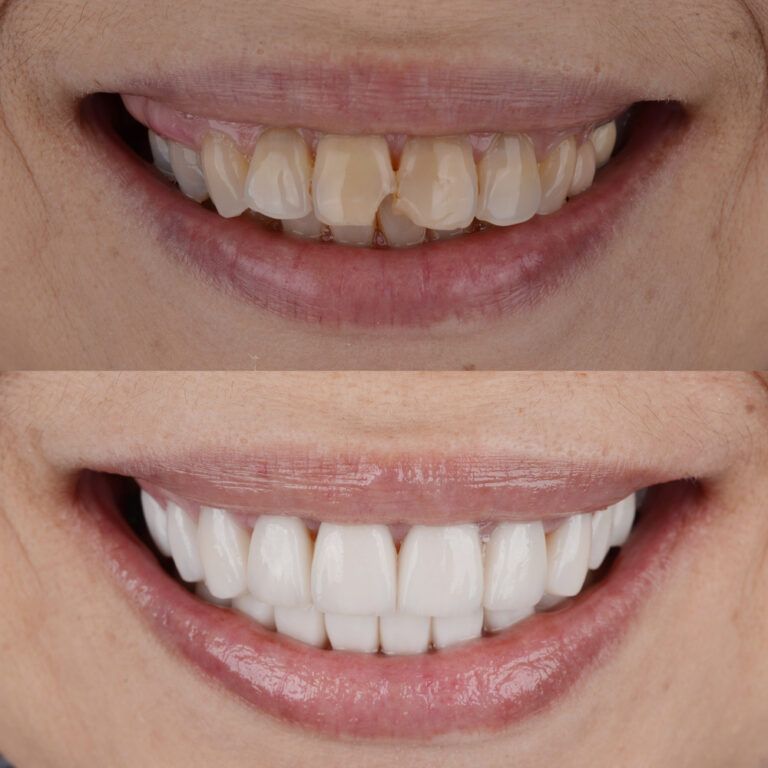 dental bonding before and after