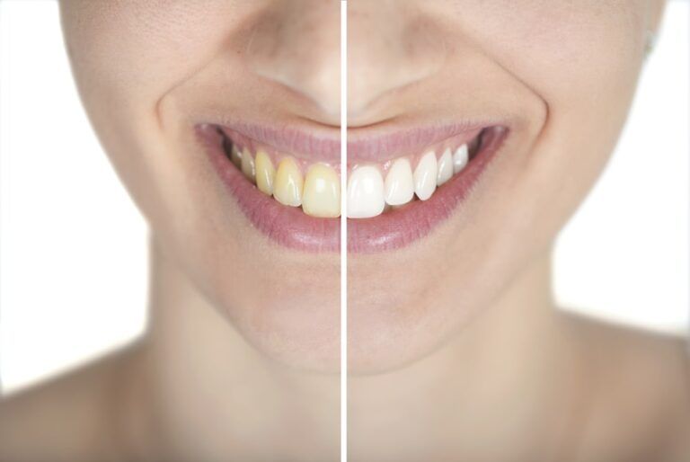 before and after teeth whitening