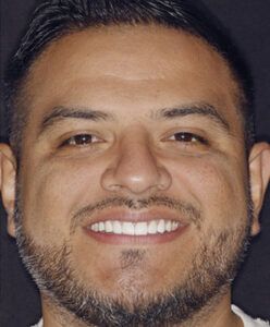 M OrthoPulse Invisalign, Veneers Full After