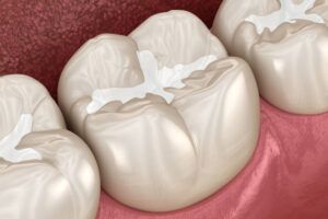 Molar Fissure dental filling