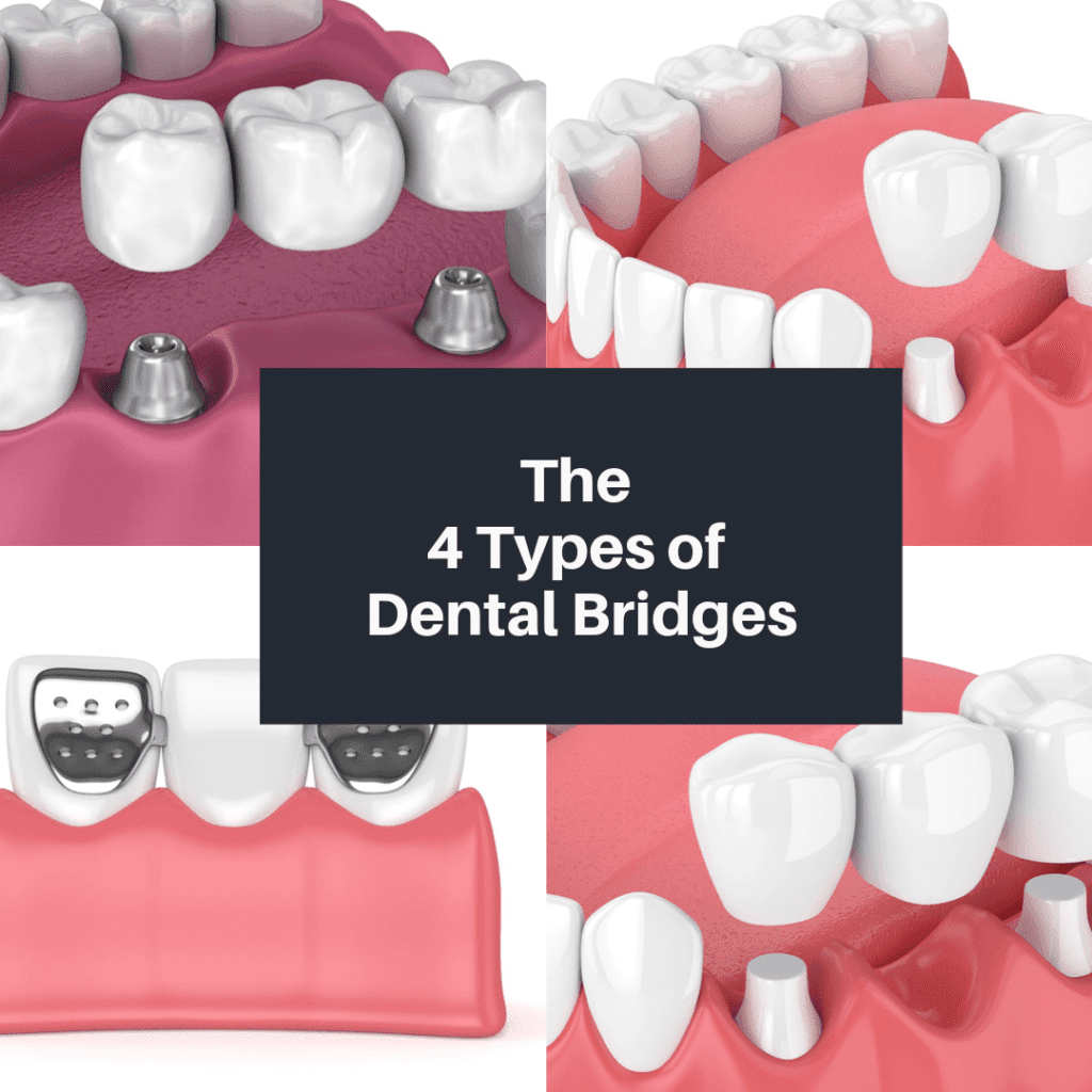 The-4-Types-of-Dental-Bridges
