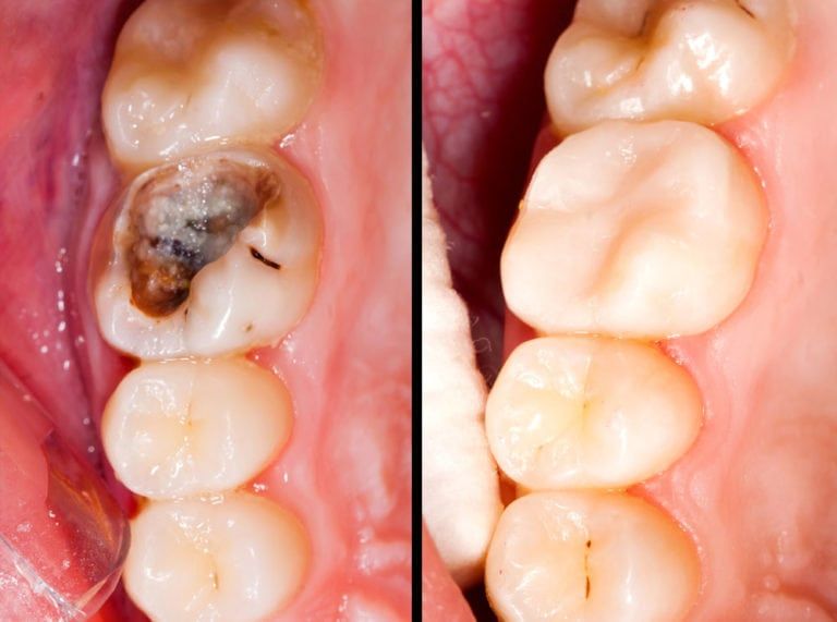 Tooth decay before and After