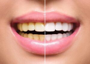 Tooth-Whitening before and after