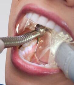 Dental treatment process