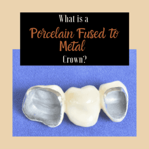 What-is-a-Porcelain-Fused-to-Metal-Crown