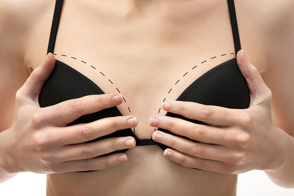 Young female body with marks for plastic operation