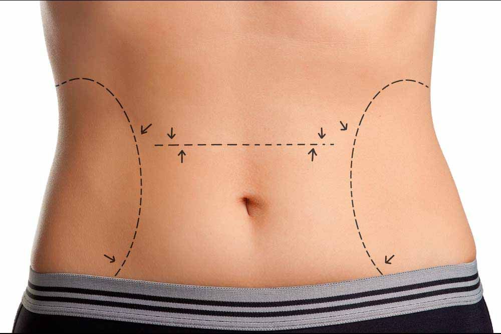 Tummy marked for plastic surgery