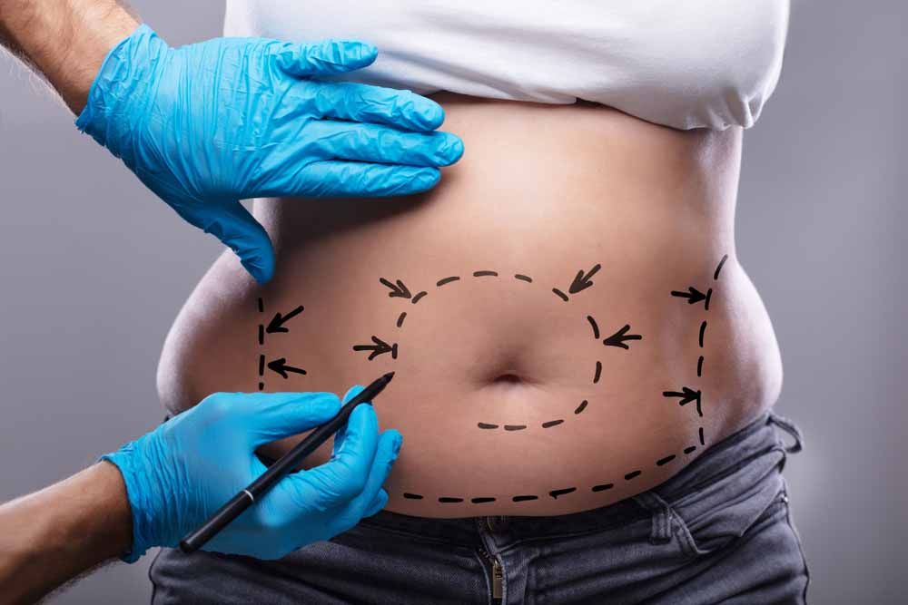 Plastic Surgeon In Blue Gloves Drawing On Woman's Stomach With Pen For Surgery