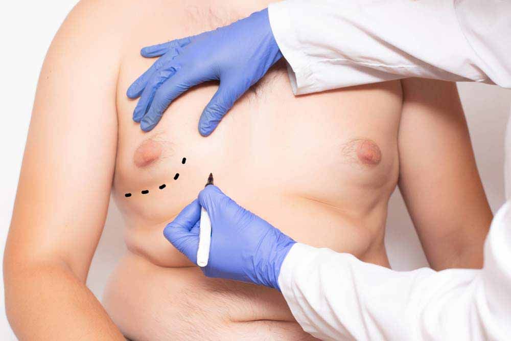 Plastic surgeon preparation before surgery to reduce breasts in men