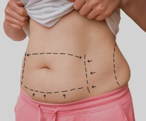 liposuction and Lipo360 are popular plastic surgery procedures