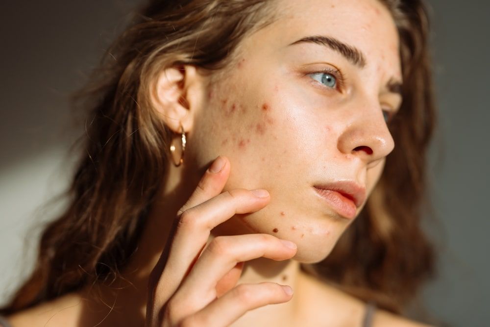 Pimples and acne on the woman's face. Medicine and cosmetology concept