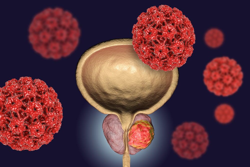 Viral ethiology of prostate cancer. 3D illustration
