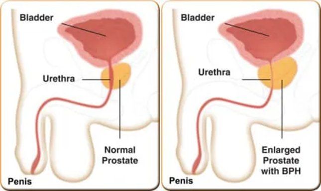 Enlarged Prostate BPH Milford MA Urology Specialists of Milford