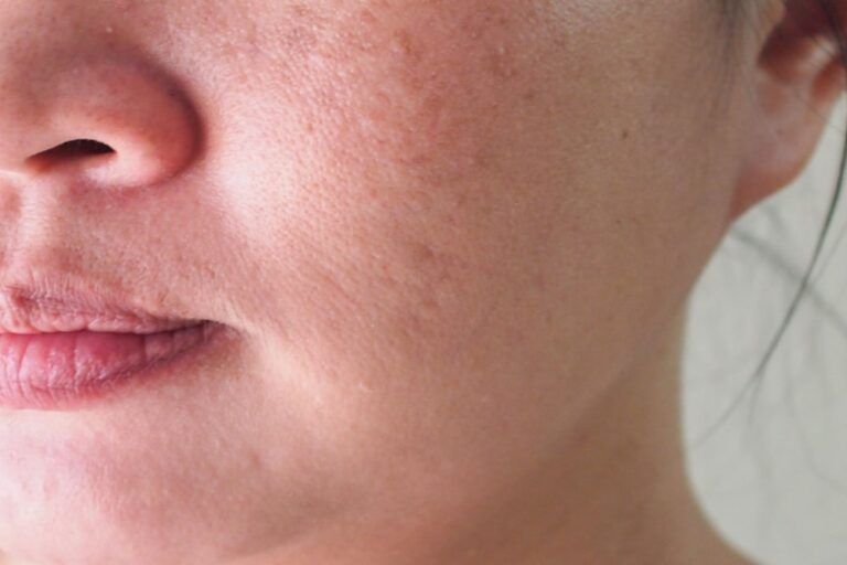 Woman before spot melasma pigmentation skin facial treatment