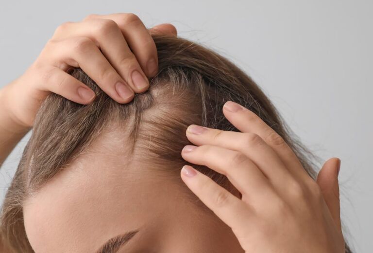 Woman before hair loss treatment