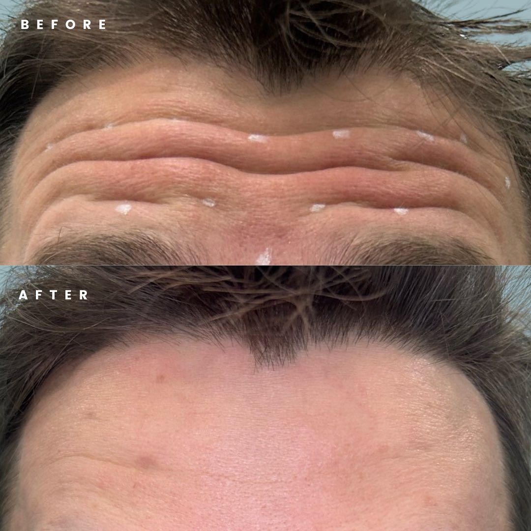 Anti-Wrinkle Injectables Before & After