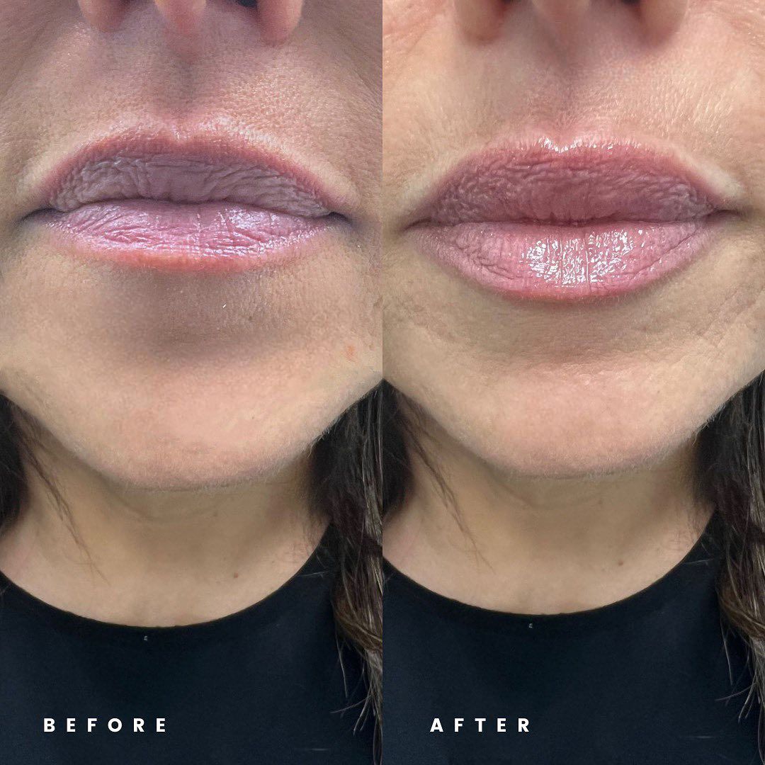 Stylage Dermal Filler Before & After