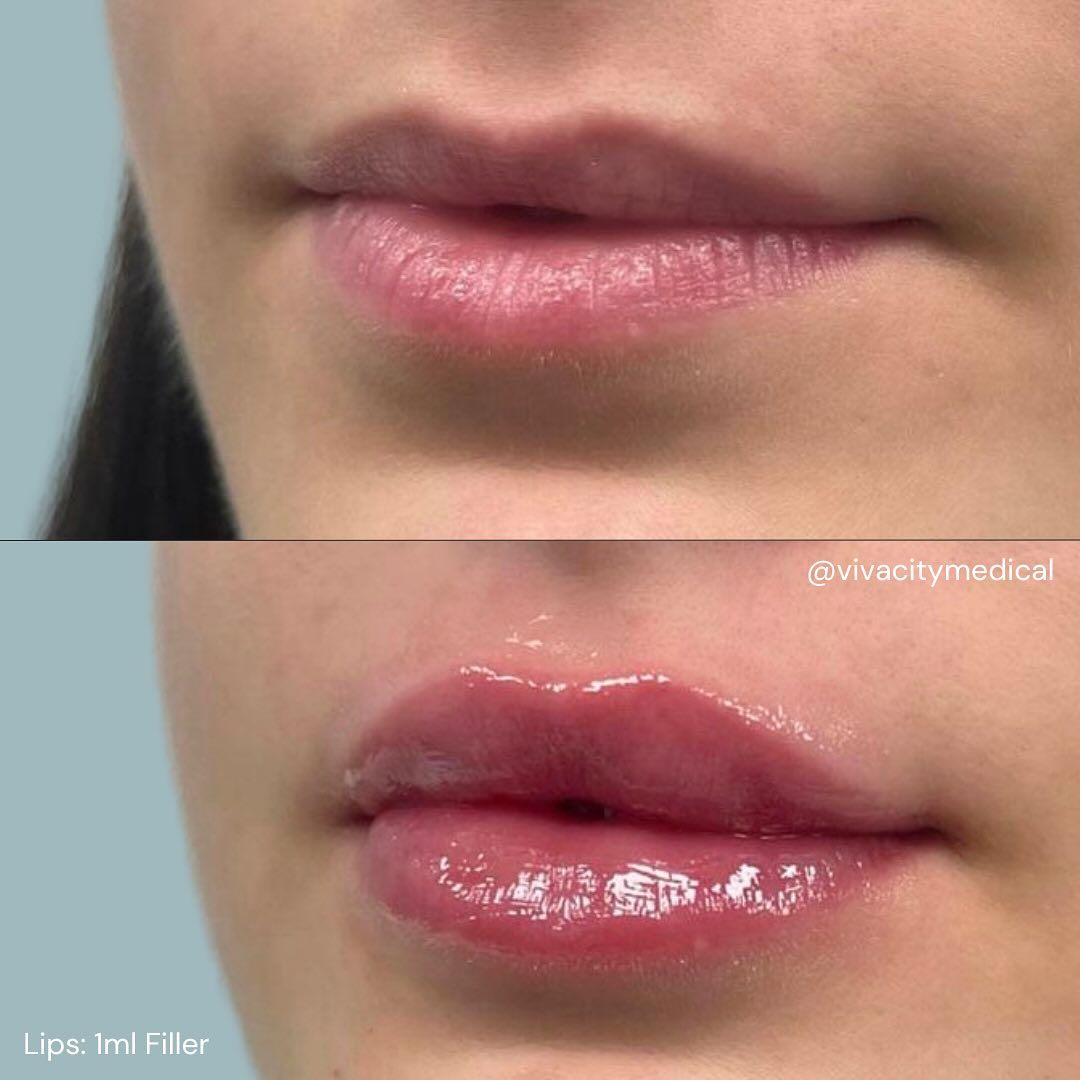 Dermal Filler: Belotero® Before & After