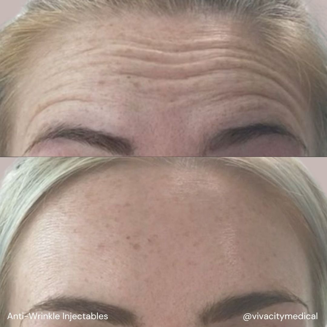 Anti-Wrinkle Injectables Before & After