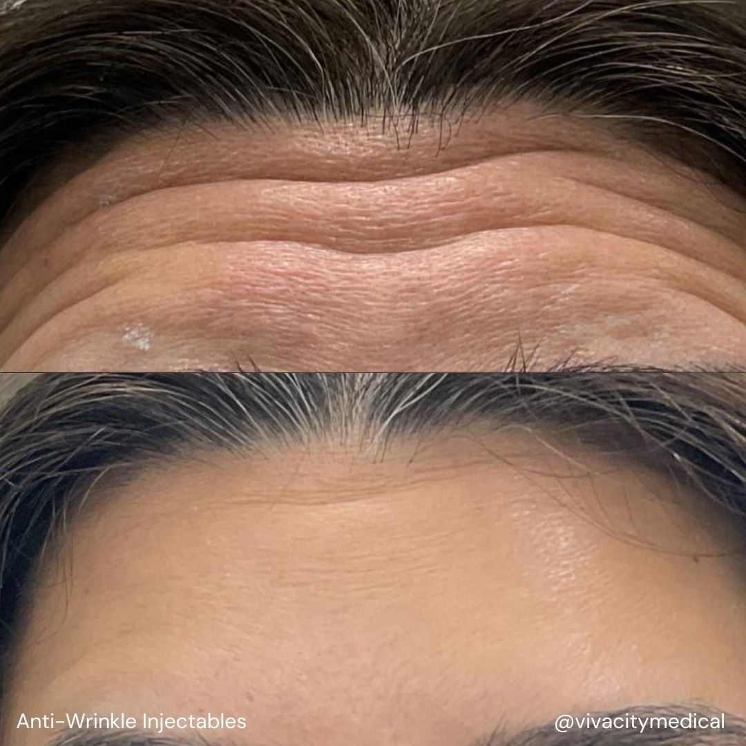 Anti-Wrinkle Solutions Before & After