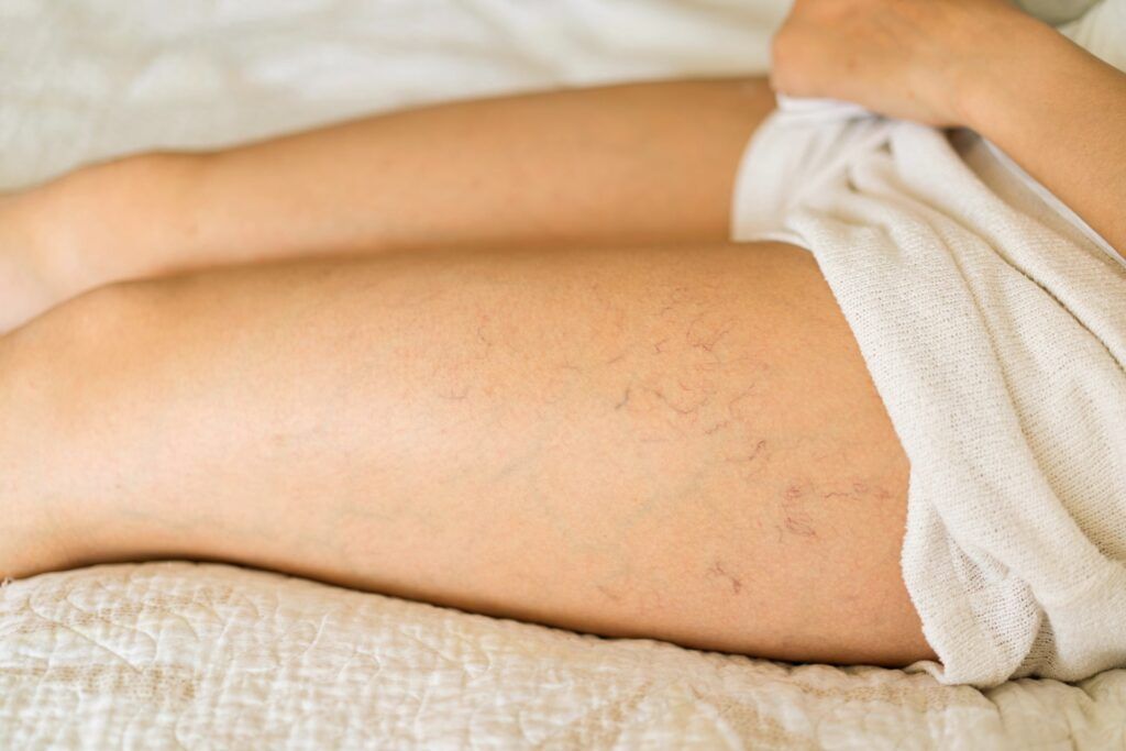 Varicose veins of small vessels on the skin of a woman's thigh.