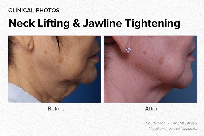 Neck Lifting & Jawline Tightening Before & After Treatment