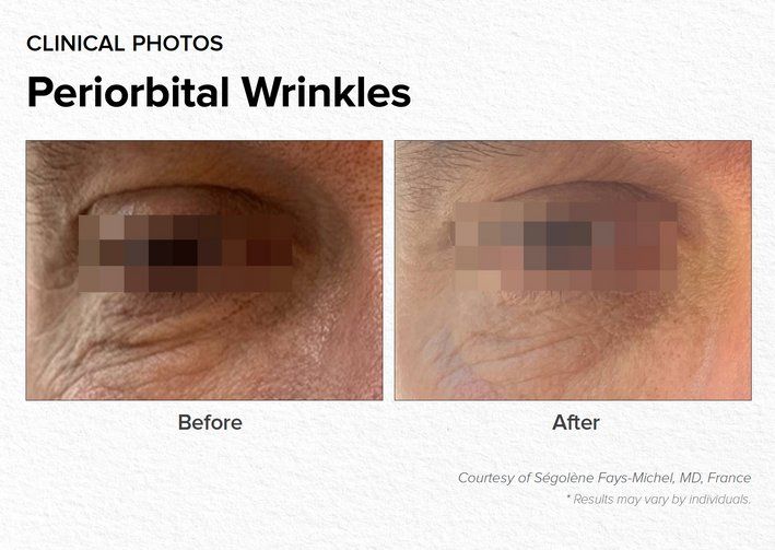 Periorbital Wrinkles Before & After Treatment