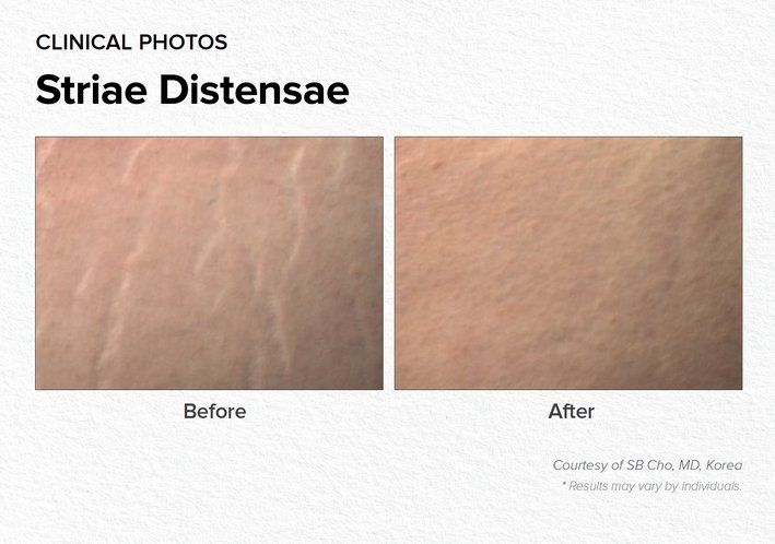 Striar Distensae Before & After Treatment