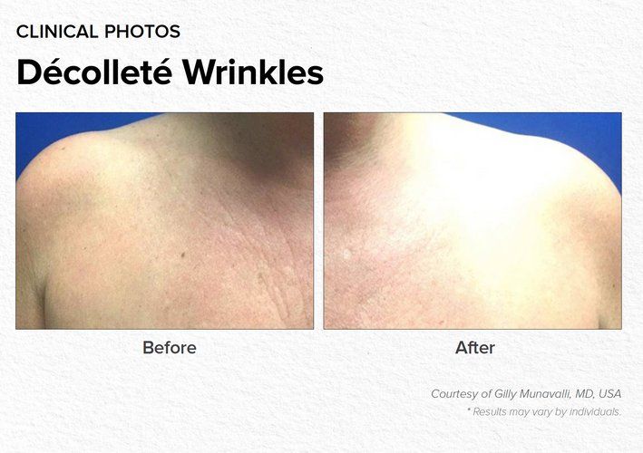 Decollete Wrinkles Before & After Treatment