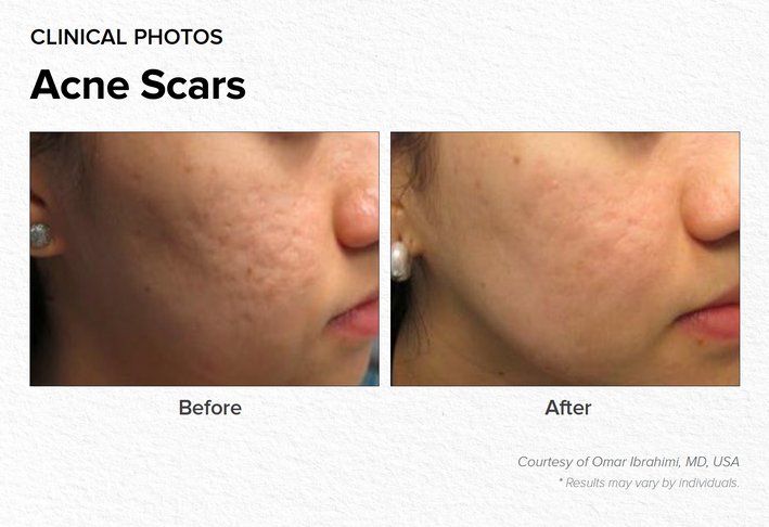 Acne Scars Before & After Treatment