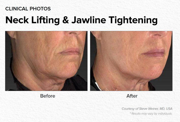 Neck Lifting & Jawline Tightening Before & After Treatment