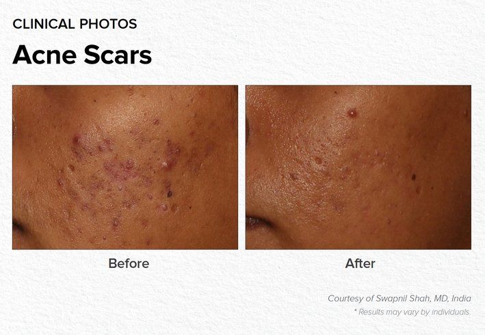 Acne Scars Before & After Treatment