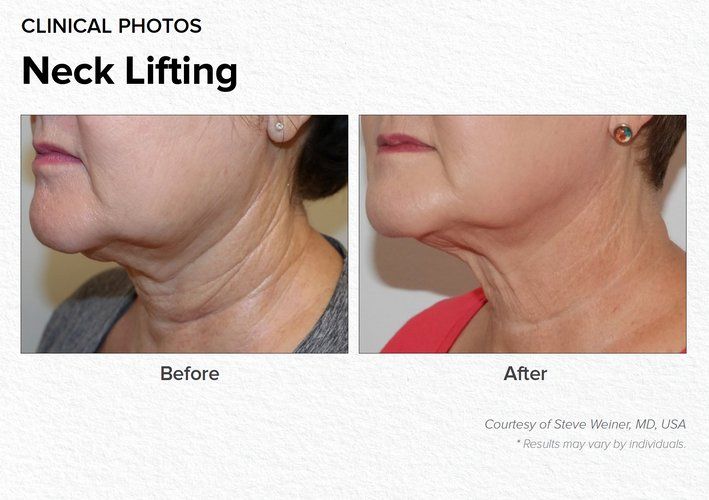 Neck Lifting Before & After Treatment