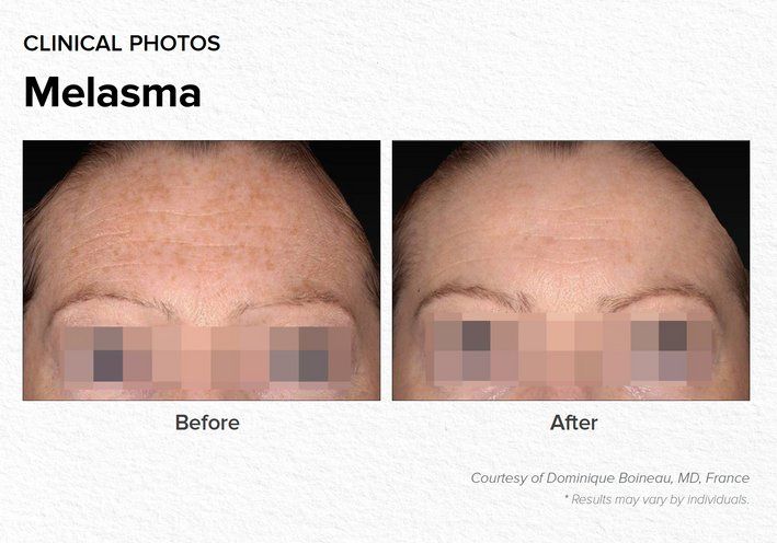 Melasma Before & After Treatment